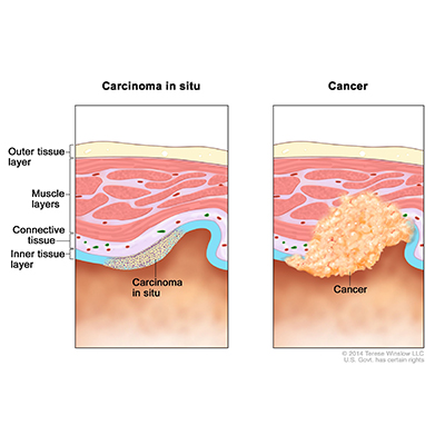 Tongue cancer treatment in Hyderabad